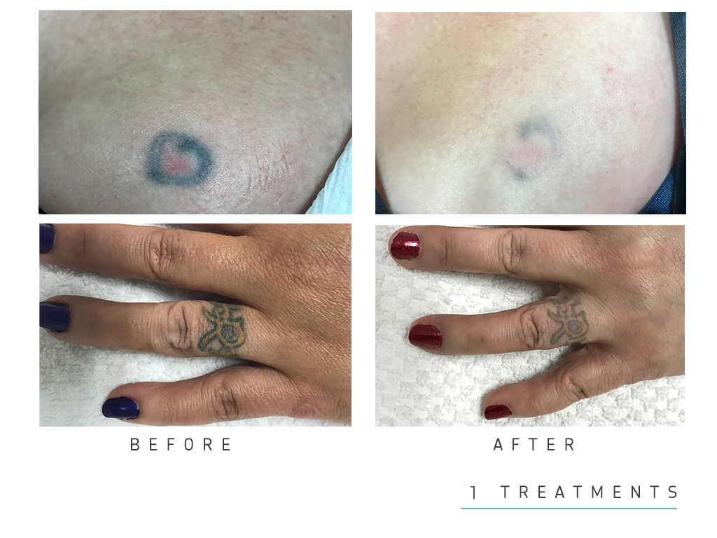 New Path Studio Laser Skin Care, Microneedling, Hair